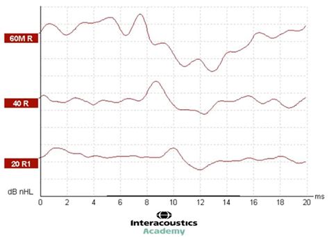 abr results interpretation